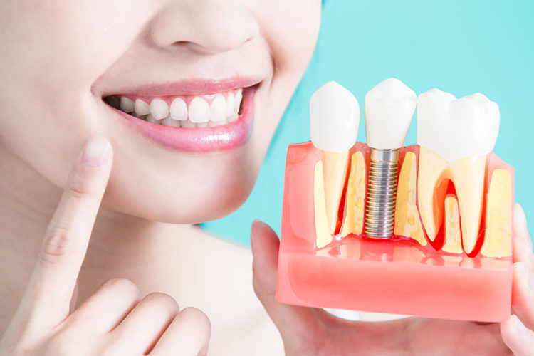 implanturile-dentare