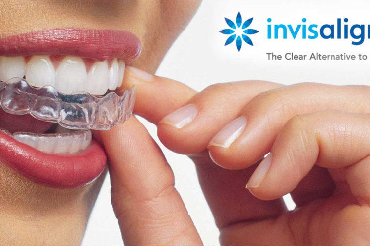 aparat-dentar-invisalign