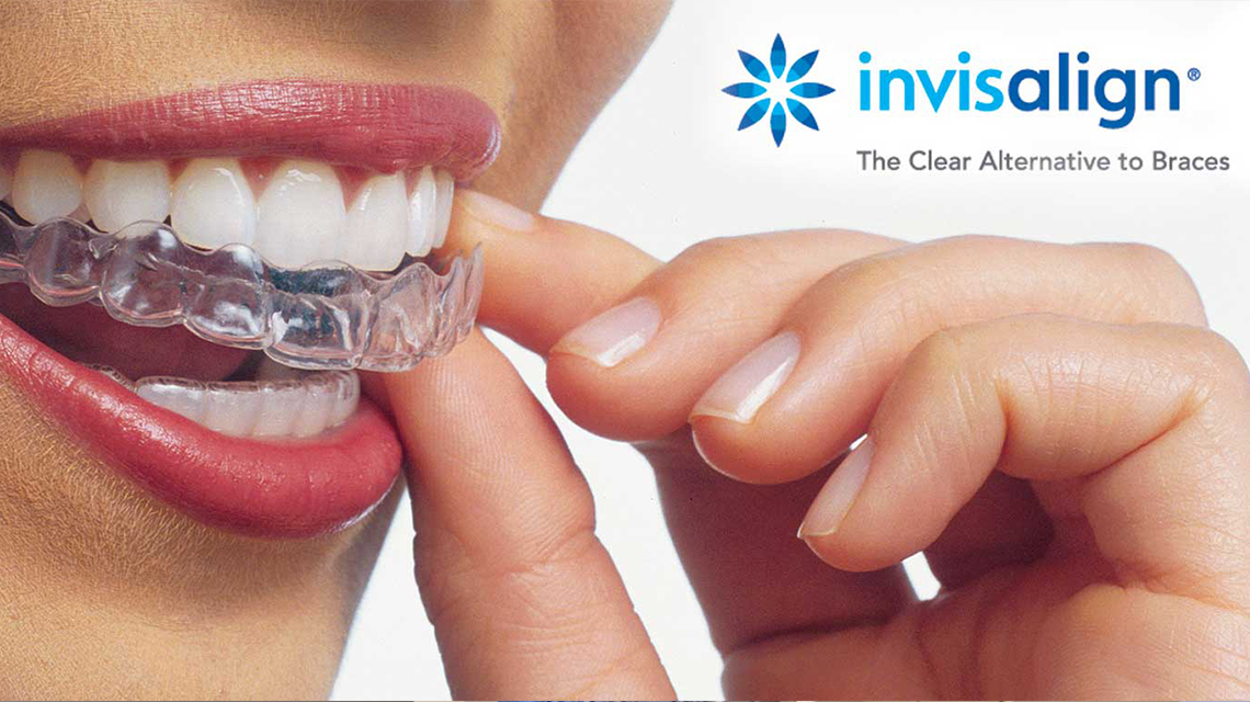 aparat-dentar-invisalign